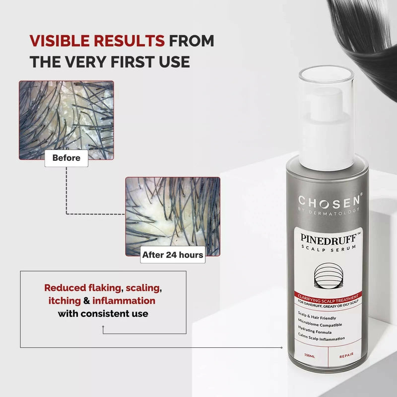 Chosen Pinedruff Scalp Serum Best Dandruff Control Treatment Solution With Pycnogenol