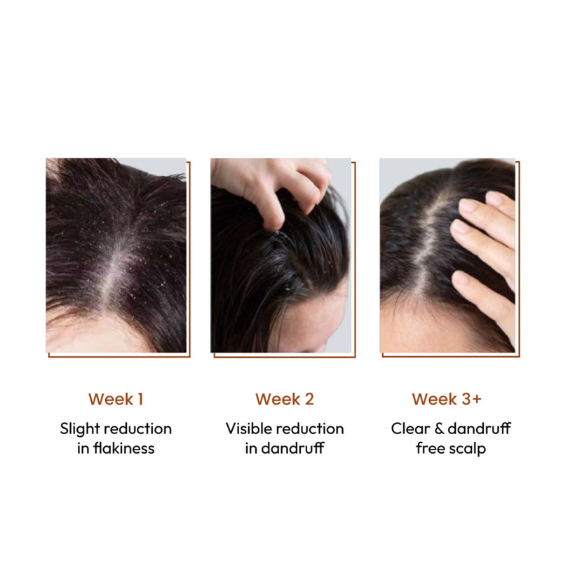 SANCTUS 4% Dandelix Pro Anti-Dandruff Hair Serum For Scalp