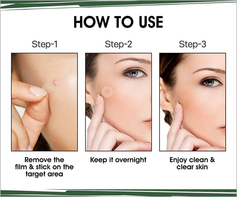 Urban Yog Acne Pimple Patch - Limited Time Offer