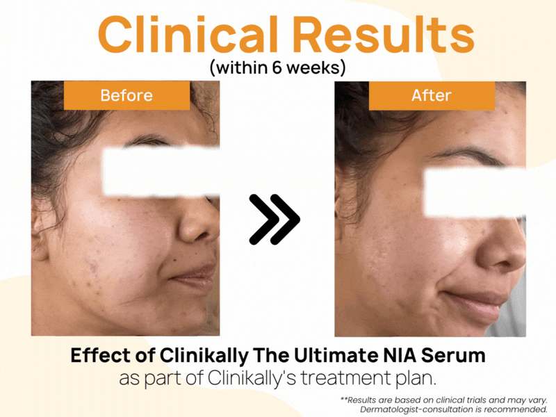 Clinikally The Ultimate NIA (10% Niacinamide) Serum