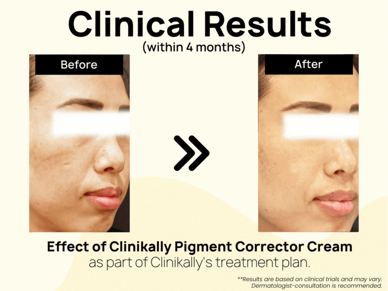 Clinikally Pigment Corrector Cream