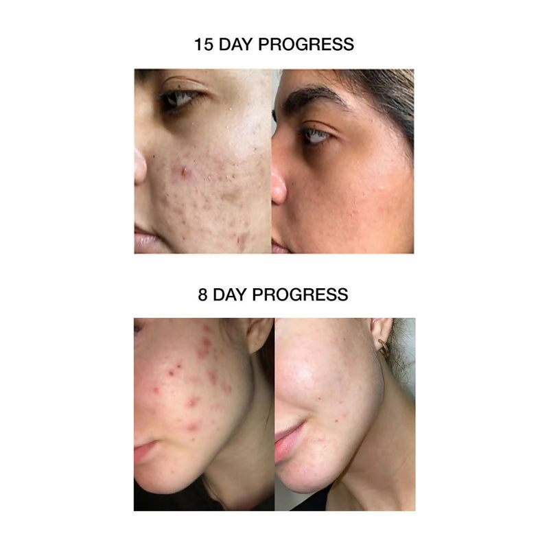 Skog Acne Clarifying Gel