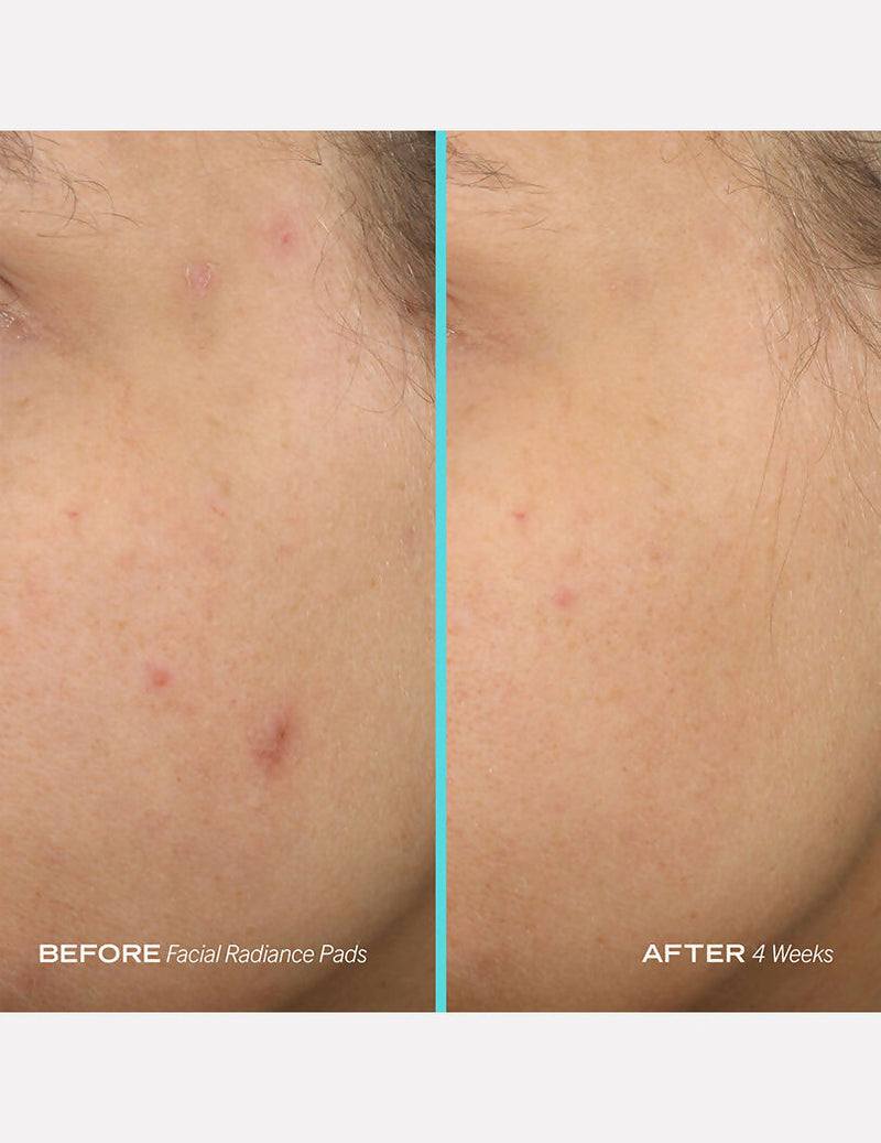 First Aid Beauty Facial Radiance Pads
