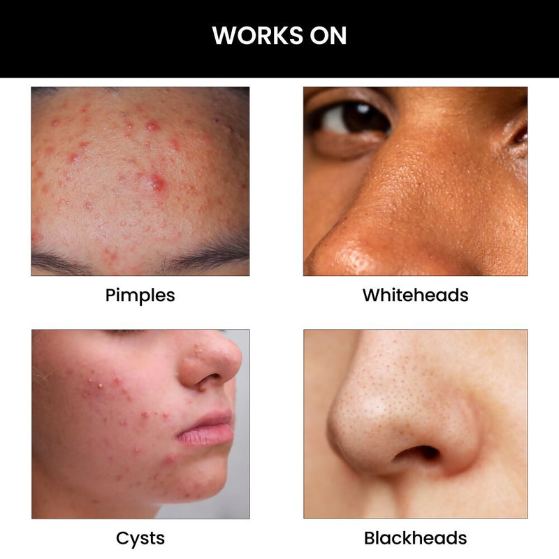 ThriveCo Goodbye Acne Kit