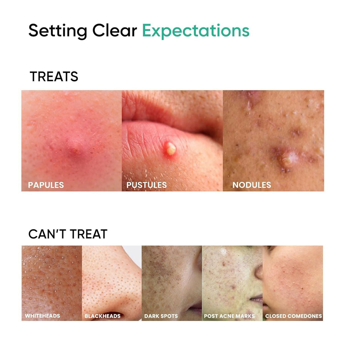 SkinInspired AcNil3 Rapid Spot Corrector