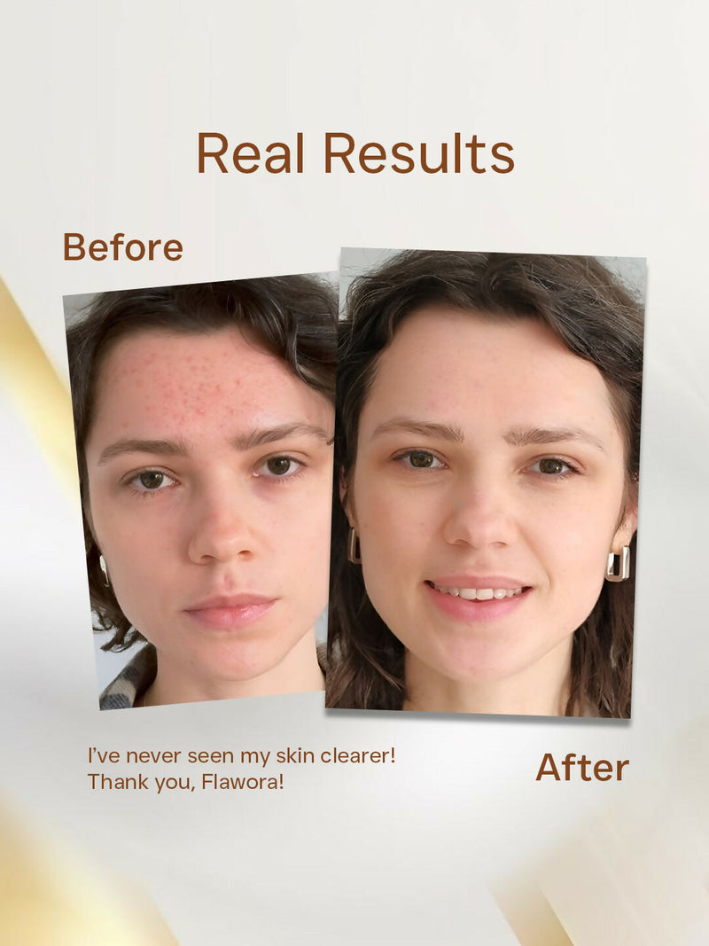 Flawora Anti Acne Serum to reduce Blackheads, Open Pore and D-Tan Lotion for Pigmentation & Tan Removal